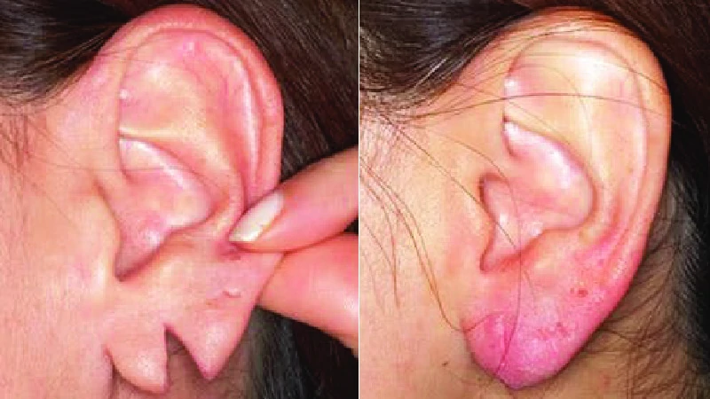 Ear Lobe Repair - Velura Clinic